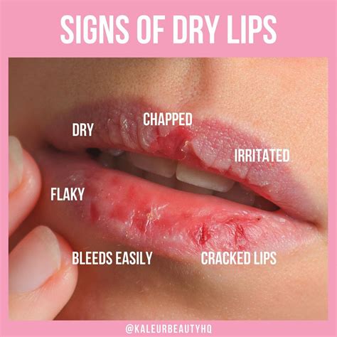 Cracked Bleeding Lips