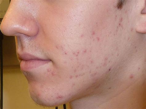 teen acne   treat prevent  common skin condition