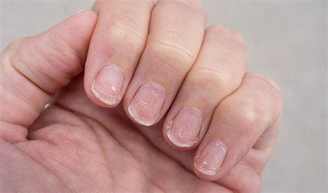 Porque As Unhas Descamam - Por que as unhas descamam? Possíveis causas, diagnóstico e tratamento ...