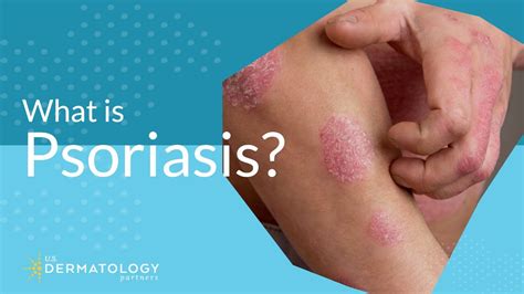 What Is Psoriasis? - YouTube