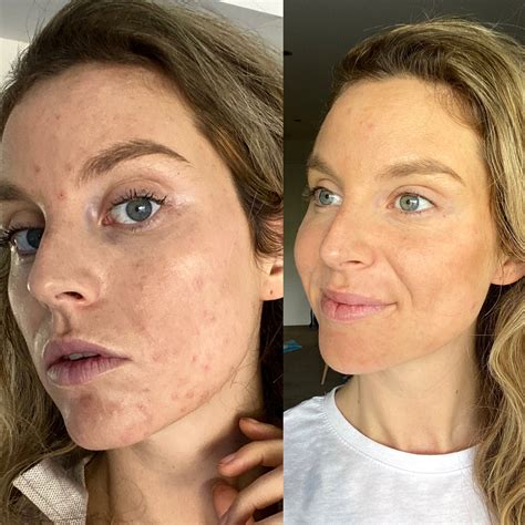 pcos    acne