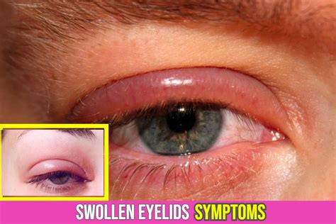 swollen eyelids symptoms  shouldnt ignore