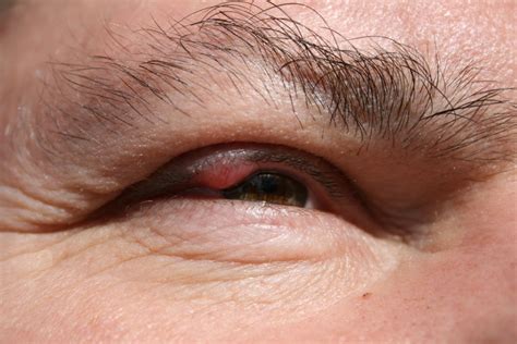 eyelid inflammation blepharitis  symptoms  treatment