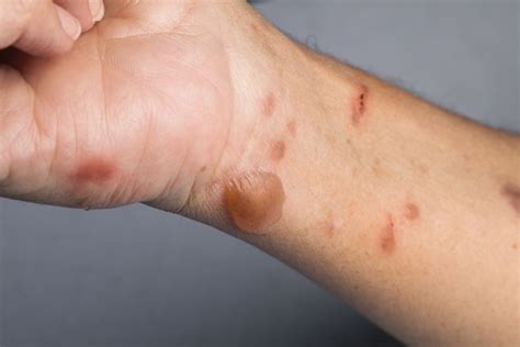 blisters types symptoms  diagnosis treatment
