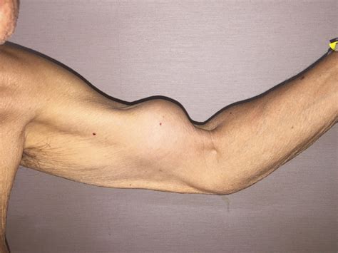 Pop-Ow! 'Popeye' Deformity Can Be A Painful Armful | NCPR News