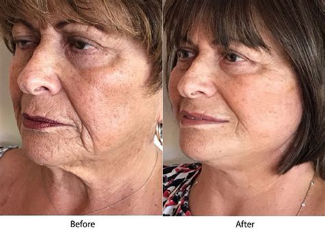Mini Facelift San Jose, CA | Palo Alto Mini Face Lift