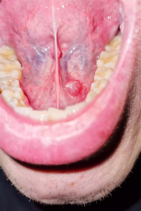 what are bumps on tongue called 7
