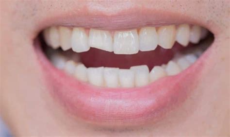 A Comprehensive Guide To Fix Your Chipped Teeth