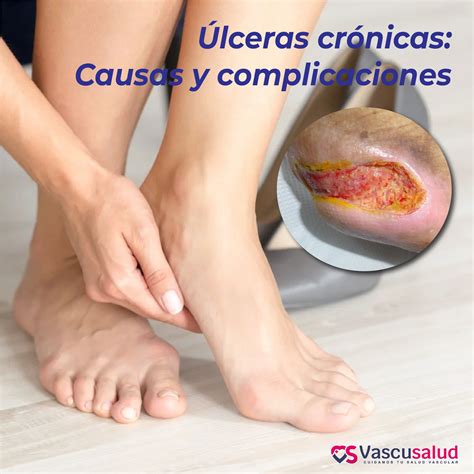 Ulceras En Piernas Fotos 6