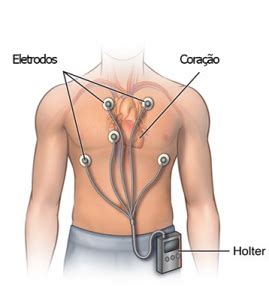 Para Que Serve O Exame Holter