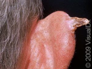 cutaneous horn  diagnosis  treatment skinsight