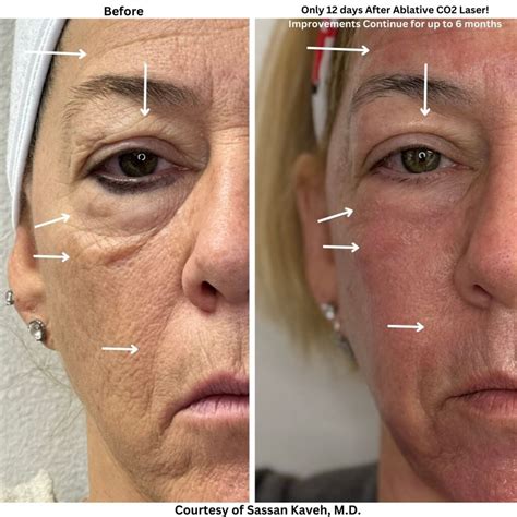 laser resurfacing  eyes    surgical fix  fine