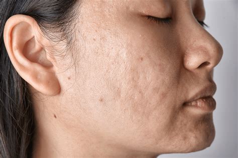 Types of Acne Scars & How to Treat Them | Dr. Dennis Gross