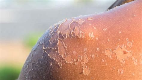 Como Tirar Queimado De Sol Da Pele - Queimadura de sol - Consequências na pele, como evitar e tratamentos
