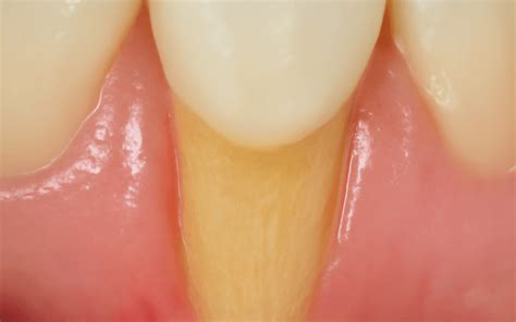 Raiz do Dente Exposta: Causas e Soluções - MAXICLIN
