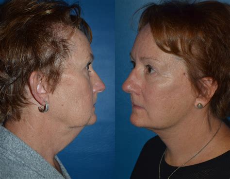 Rhytidectomy Before & After | Dr. George Miguel