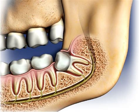 Are your wisdom teeth causing you pain and discomfort? Wisdom teeth ...