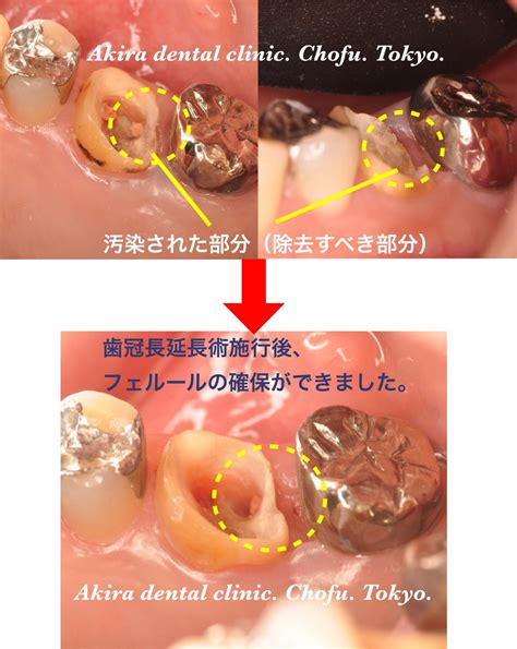 crown lengthning operation