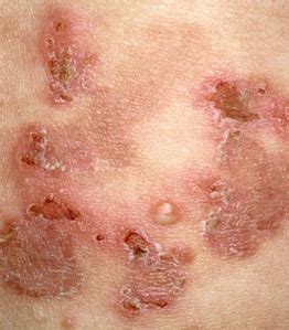 pemphigus clinical gate