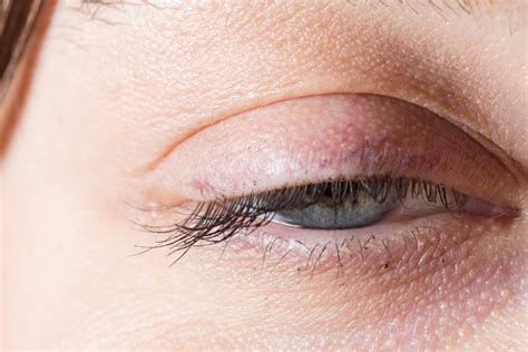 bell's palsy face exercise 7