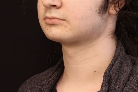 Before & After Chin Implant Procedures in Newton Centre MA | Dr. Russo