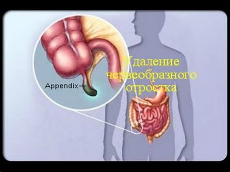 Удаляем червеобразный отросток! Аппендэктомия! ВНИМАНИЕ 12+! - YouTube