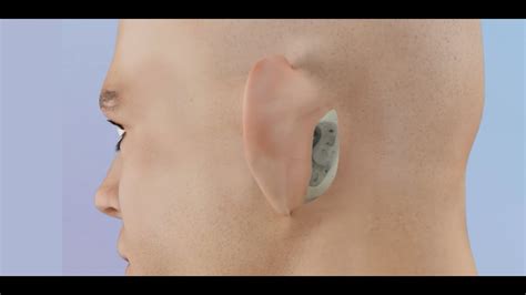 Mastoid Surgery (Basic to Radical Mastoidectomy) - YouTube