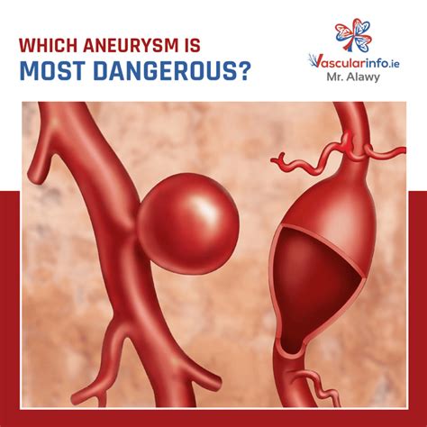 abdominal aortic aneurysmaaa vascular info
