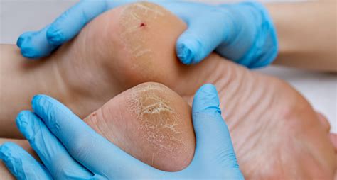 Preventing Foot Complications in Diabetes: Simple Tips for Better Health