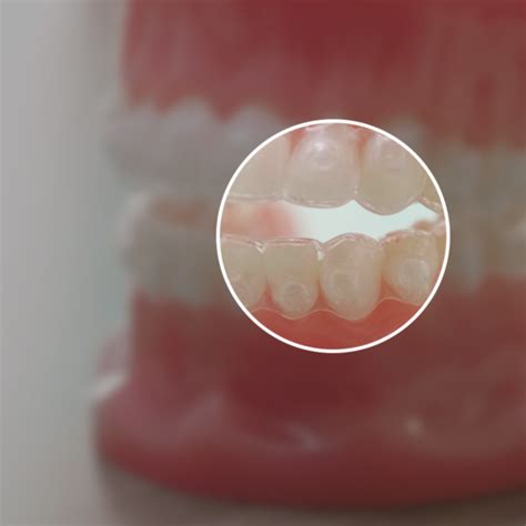 Aligners - Oasis Orthodontics