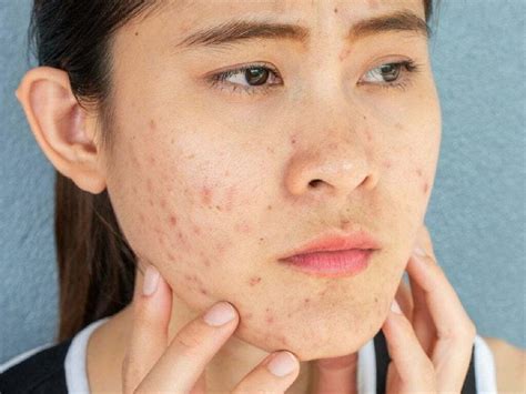 Acne Prevention: Simple Tips You Need To Follow To Avoid This Skin ...