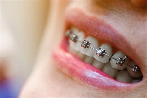 Traditional Braces vs. Self-Ligating | Simply Orthodontics Grafton