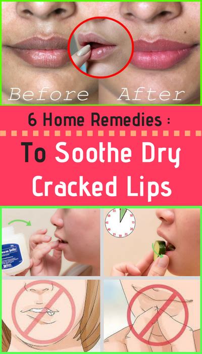 Here Are 6 Home Remedies To Soothe Dry Cracked Lips – Healthy National ...
