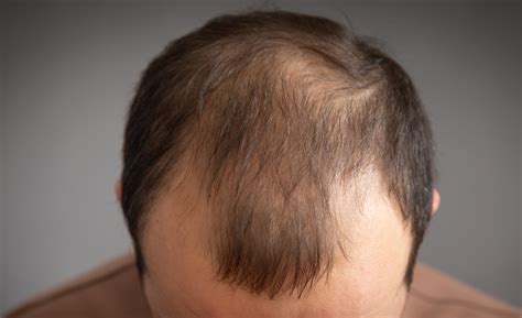 Can Microneedling Help Your Scalp Regrow Hair? – diaminyaesthetics