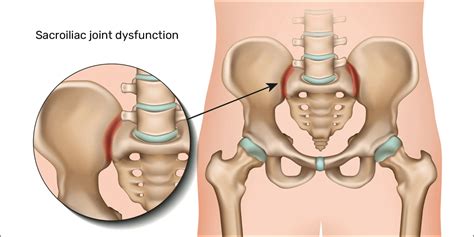 Sacroiliac joint dysfunction sij d | Sacroiliac joint pain exercises ...