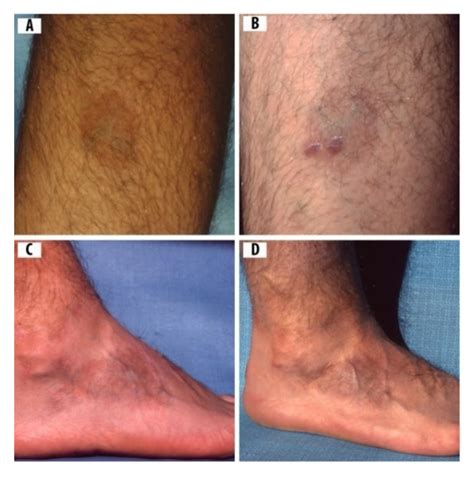 Acrodermatitis Chronica Atrophicans