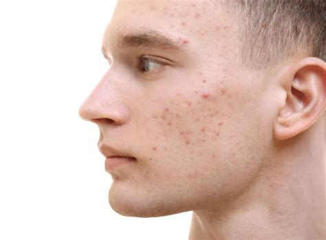 Different Types of Chronic Skin Conditions – Description, Treatment