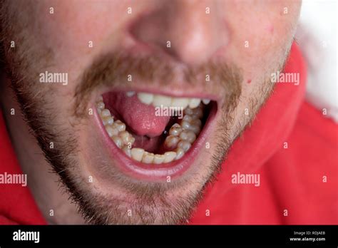 All Teeth Mouth Open