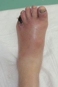 糖尿病と足の病気 | 江草玄士クリニック