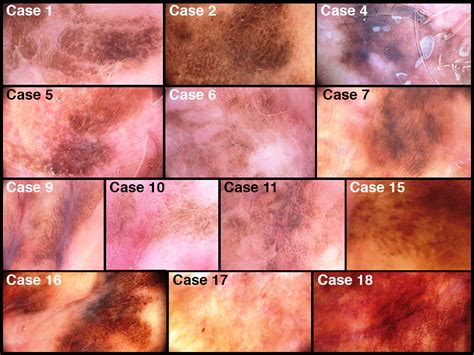 Vulvar Melanoma Staging