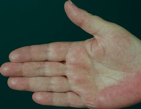 Palmar Erythema - Pictures, Causes, Symptoms, Treatment