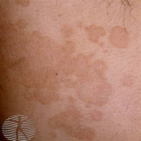 tinea versicolor koh tinea versicolor pityriasis versicolor rgnm