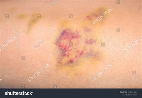 bruises  human body severe bruise stock photo  shutterstock