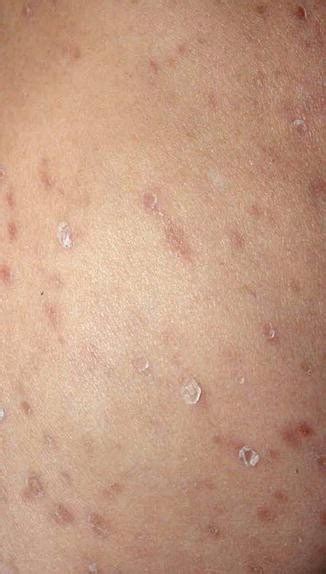 Pityriasis Lichenoides Chronica | SpringerLink