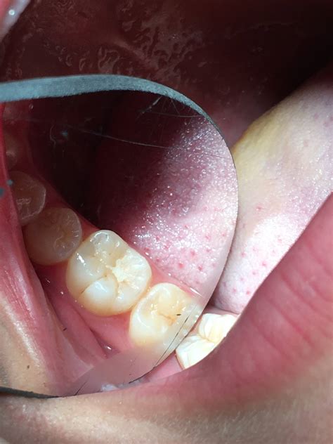Caries in the pit and fissures was... - Melody Dental Care
