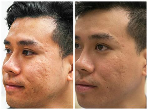 Acne Scar Treatment: CO2 Laser + TCA Results after 5 Sessions