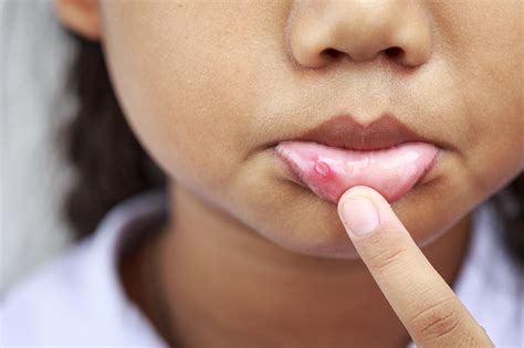 Canker Sore Vs Cold Sore Inside Lip