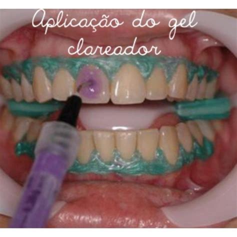 Clareador Dental Caseiro Qual O Melhor - Clareamento Dental Caseiro ou a Laser: qual o melhor?