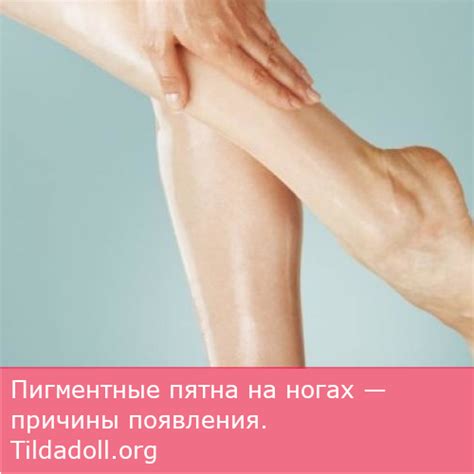 Пигментные пятна на ногах — причины появления. Что делать, если ...
