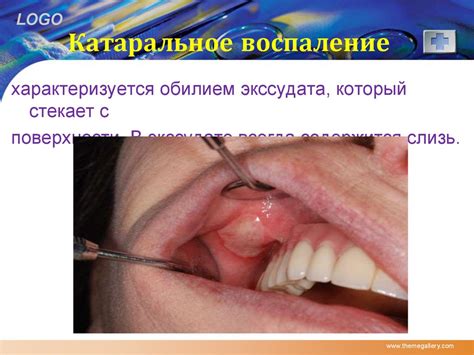 Воспаление. Факторы воспаления - презентация онлайн